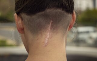 Frau trägt Aloe Vera Gel auf Pigmentflecken auf